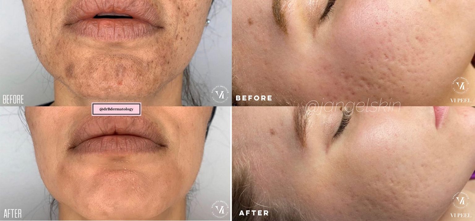 Vi Peels Allure Laser Medispa 8836